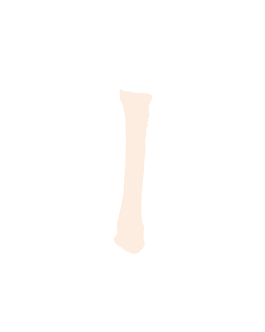 Fused Metacarpus 3 and 4
